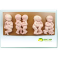 ANATOMY14(12452) Demonstrator Deformities in Infants ,8 pieces in a Series, Anatomy Models > Fetal Malformation Model 12452